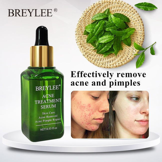 BREYLEE Acne Treatment Serum Face Facial Anti Acne Scar Removal Cream Skin Care Whitening Repair Pimple Remover For Acne Hover Image