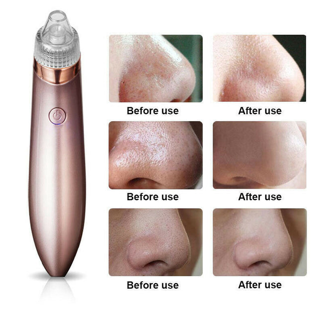 Electric Blackhead Vacuum Pore Cleaner Acne Pimple Remover Strong Suction Tool Electric Blackhead Remover Pore Vacuum Suction Diamond Dermabrasion Face Cleaner Main Image