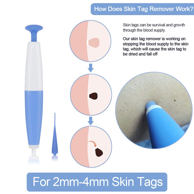 Skin Tag Removal Kit Home Use Mole Wart Remover Micro Band Skin Tag Treatment Tool Easy To Clean Skin Care Tool Main Image